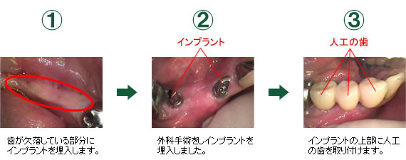 奥歯・複数本のインプラント